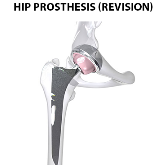 Revision Total Hip Arthroplasty